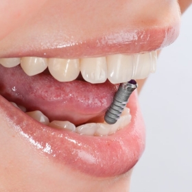 Geöffneter Mund mit Implantat