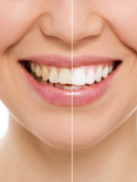 Before and after bleaching or whitening treatment, isolated