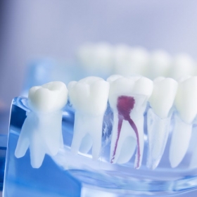 Wurzelkanalbehandlung